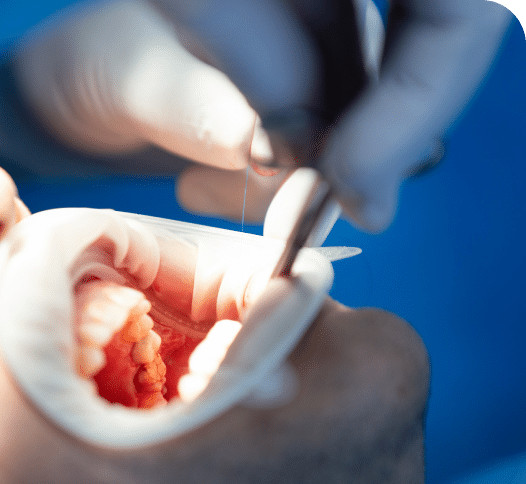 Early Cavity Detection Peterborough