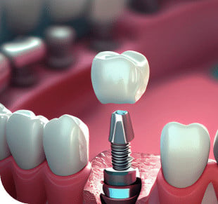 Dental Implants Services