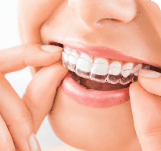 Invisalign® vs. Traditional Braces