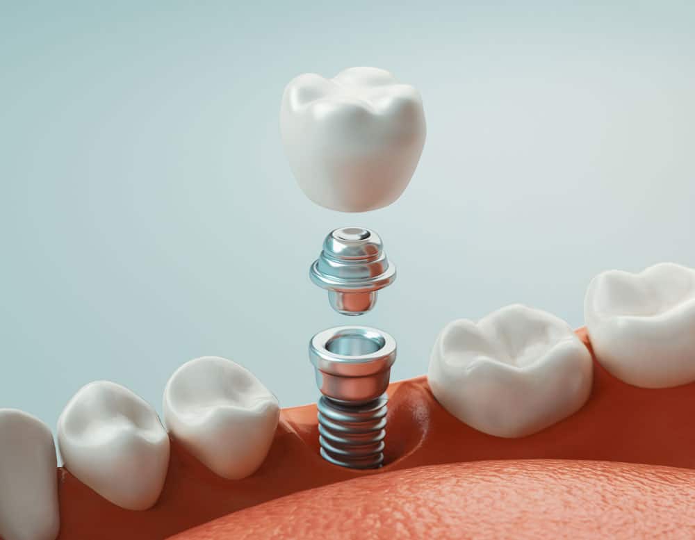Dental Implants Peterborough ON
