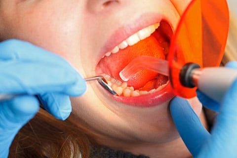 Dental fillings in Peterborough